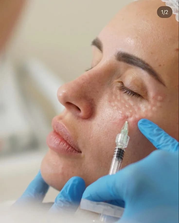 Mesoterpia con NCTF 135 HA - Blog de medicina estetica