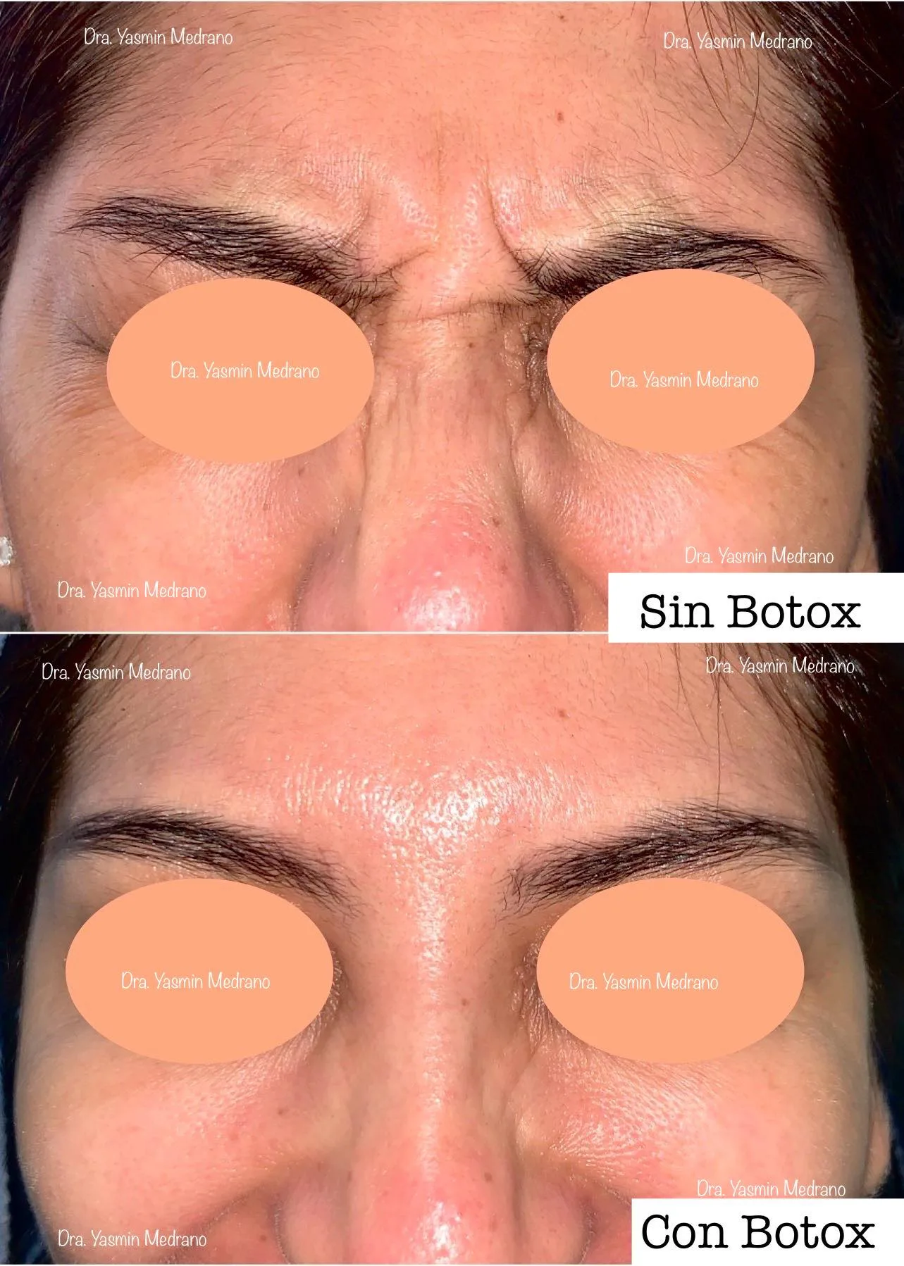 Antes — Toxina Botulínica "BOTOX"