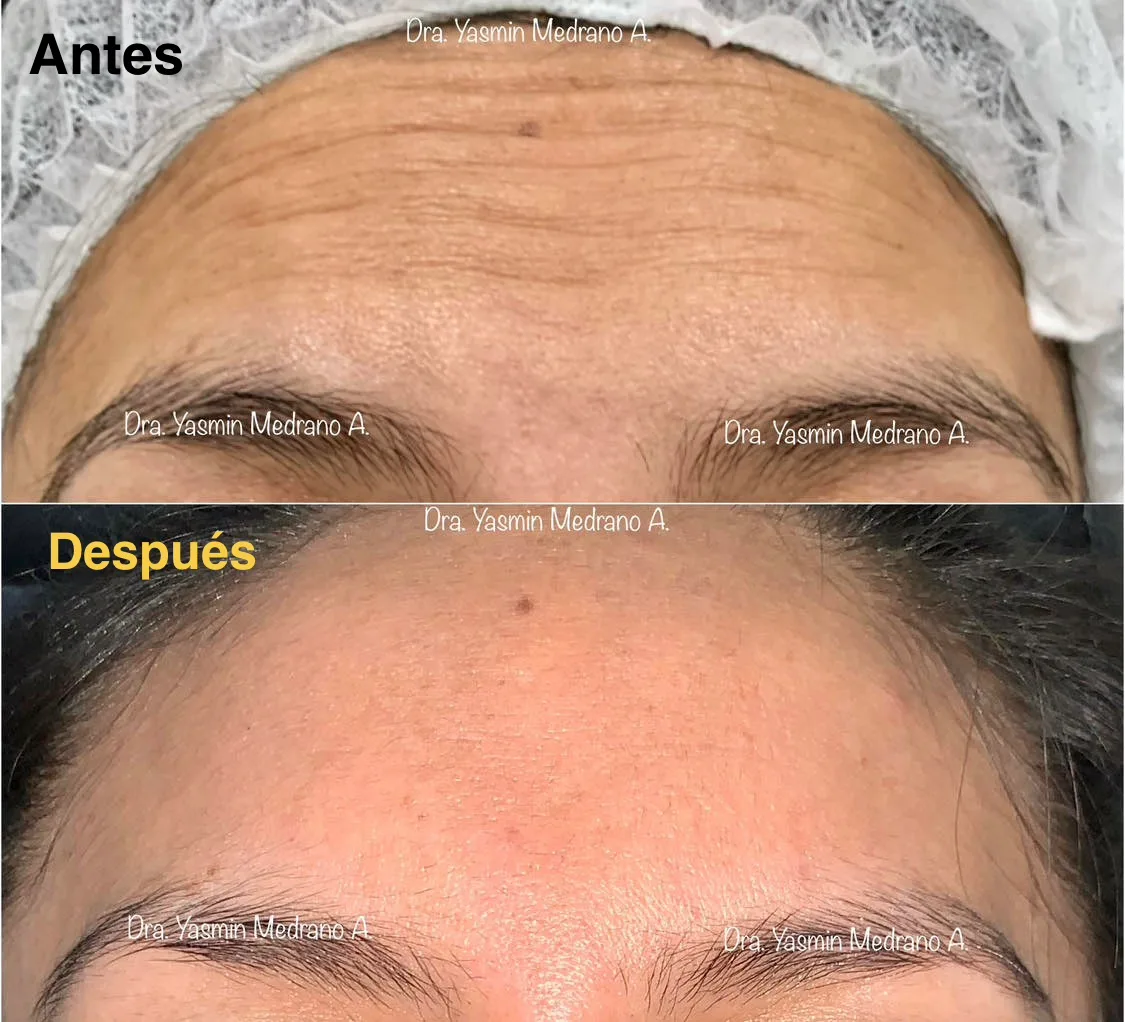 Después — Toxina Botulínica "BOTOX"