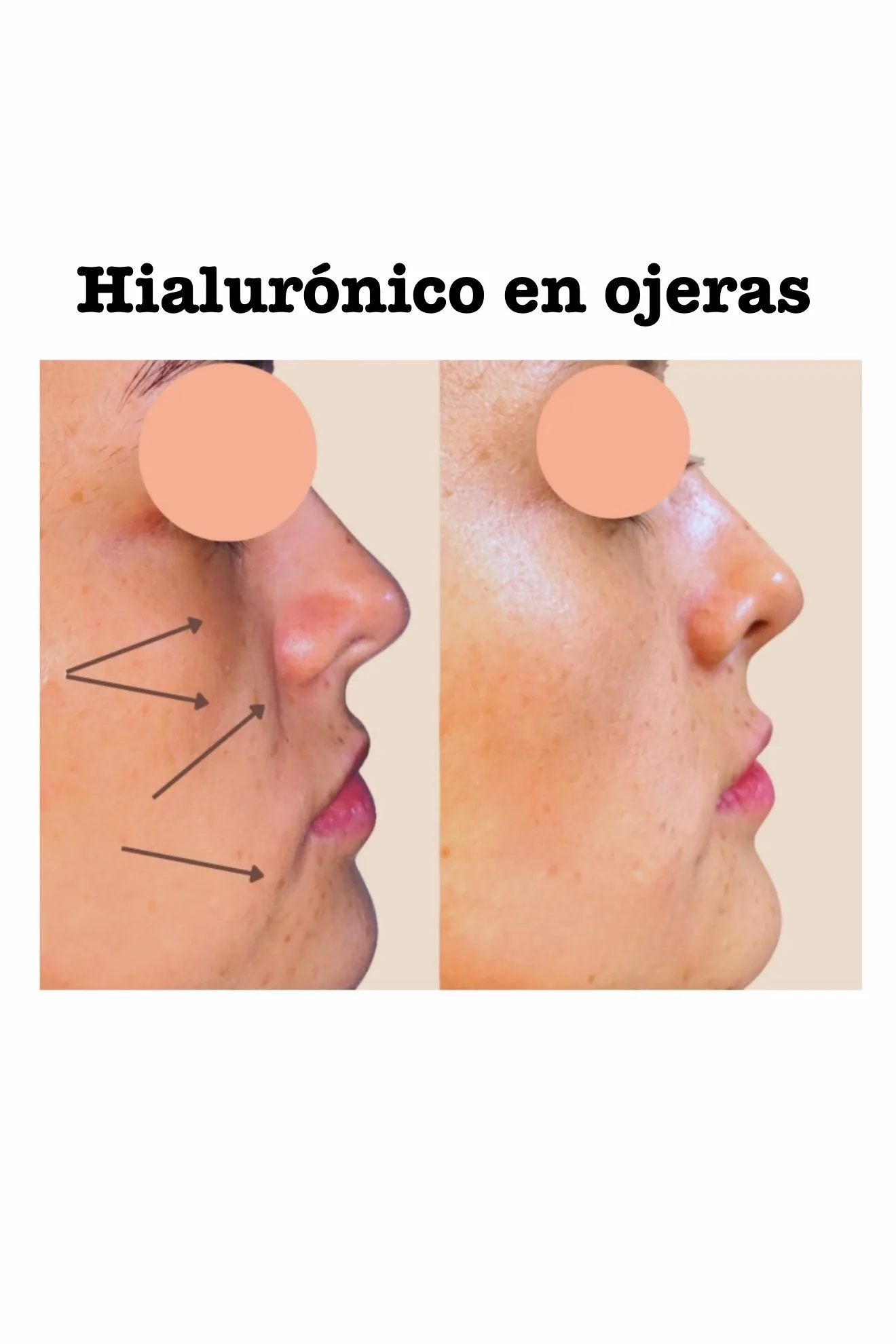 Antes — ÁCIDO HIALURÓNICO