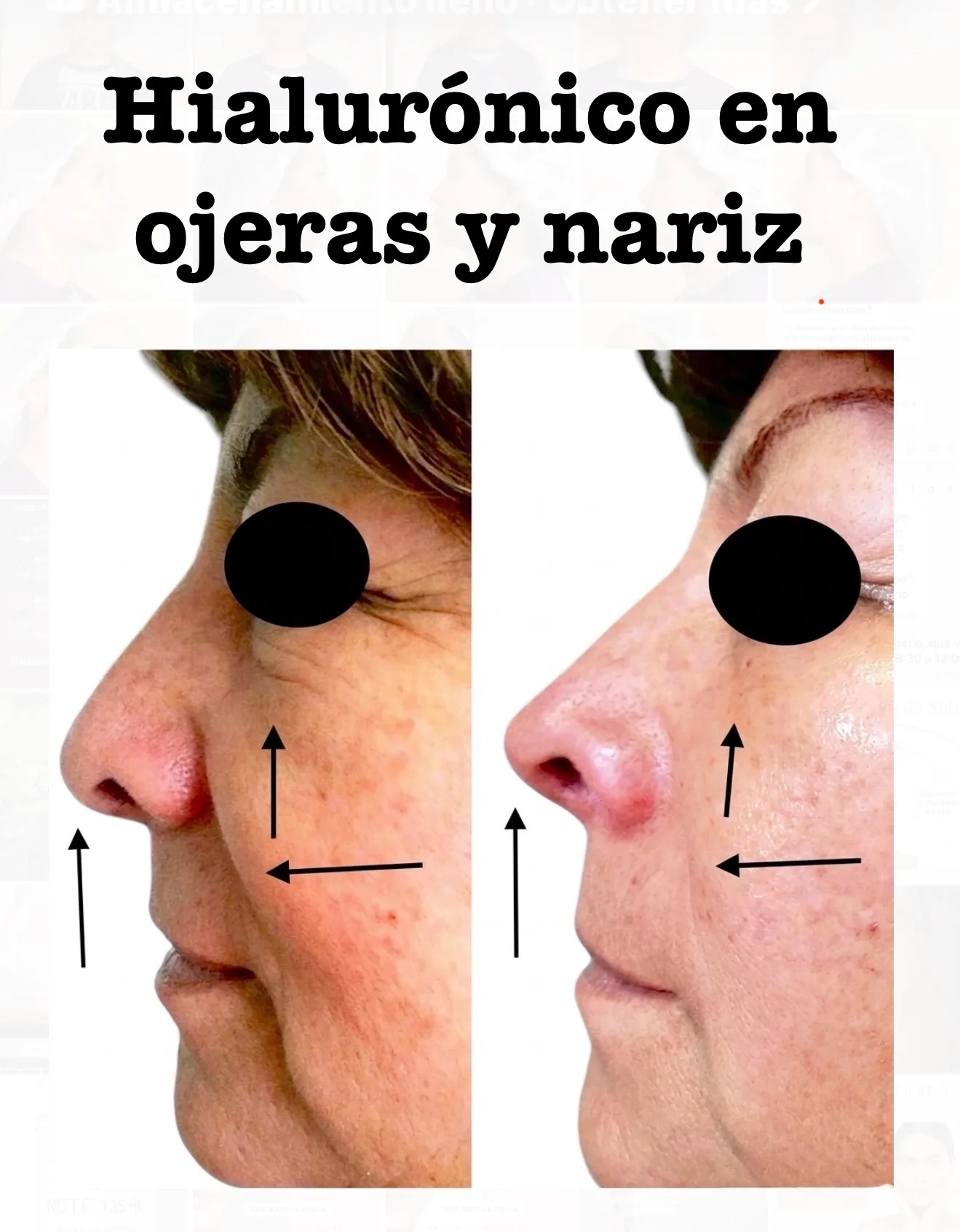 Después — ÁCIDO HIALURÓNICO
