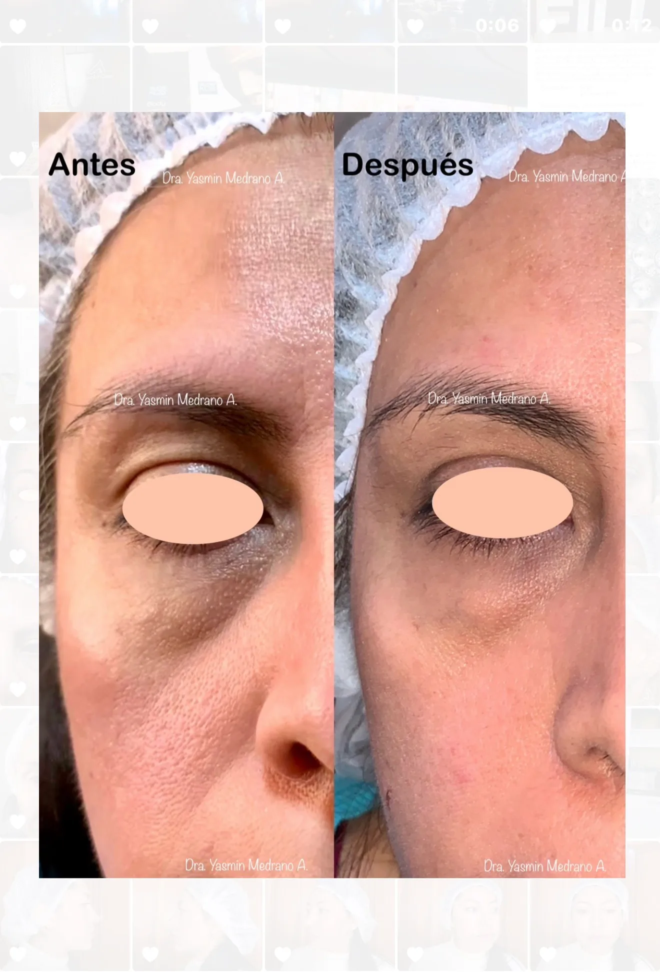 Antes — NCTF 135 HA - ORO ROSA