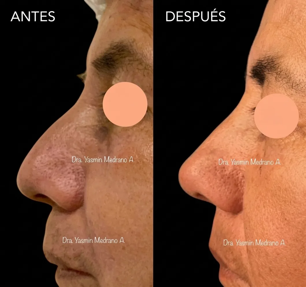 Antes — RINOMODELACIÓN con HIALURÓNICO
