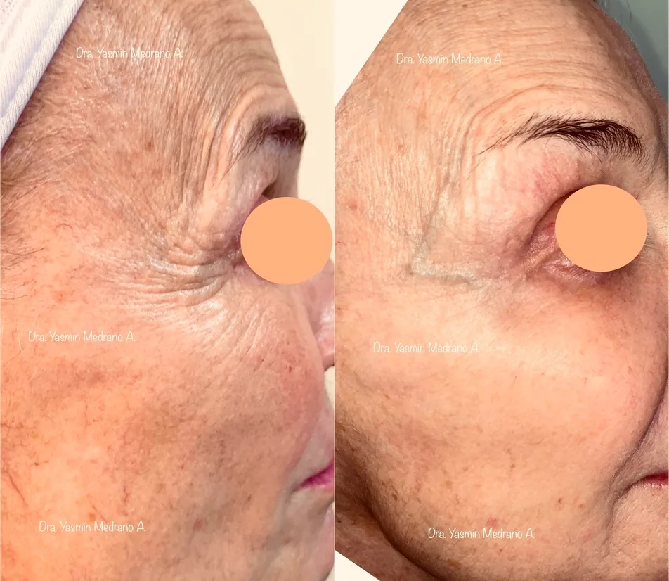 Antes — MESOTERAPIA