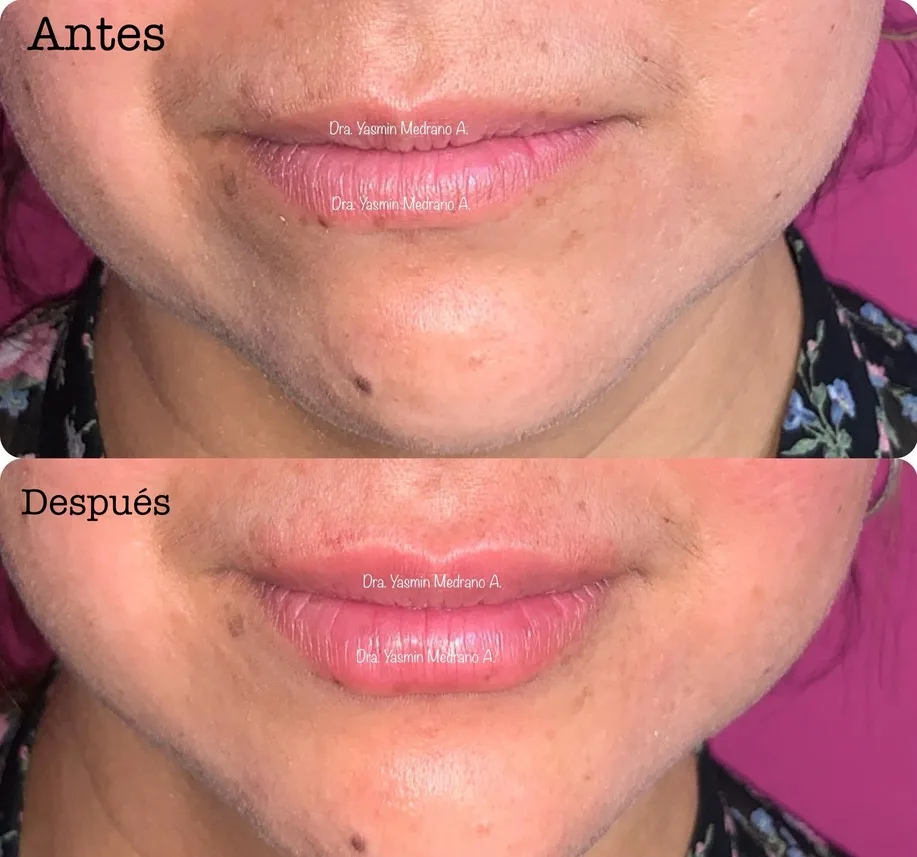 Antes — AUMENTO Y PERFILADO DE LABIOS CON HIALURÓNICO
