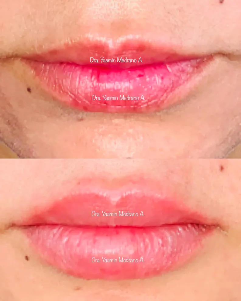 Después — AUMENTO Y PERFILADO DE LABIOS CON HIALURÓNICO