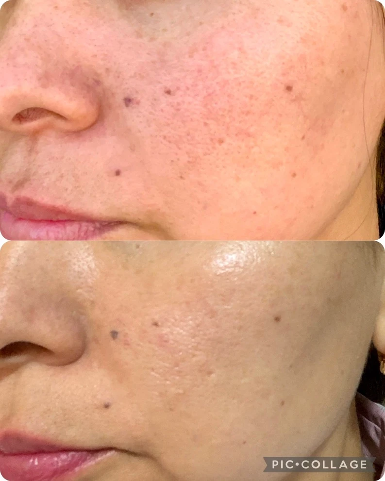 Antes — PEELING QUÍMICO