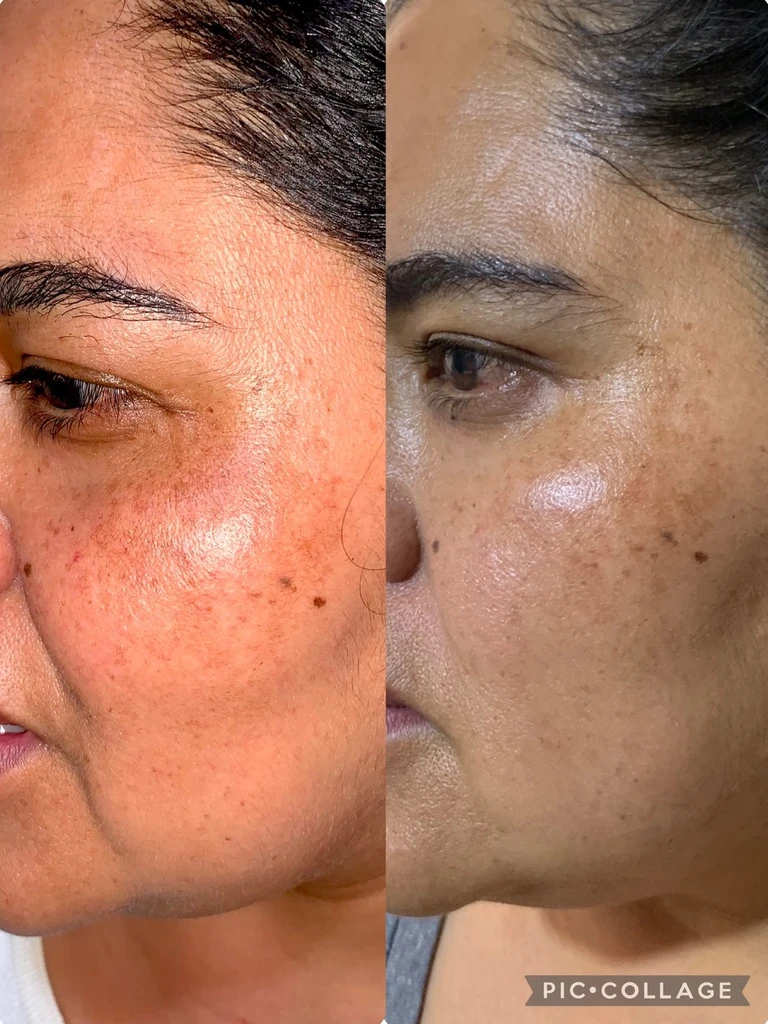 Después — PEELING QUÍMICO